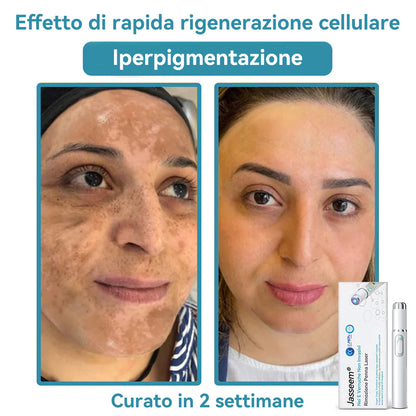 𝐉𝐚𝐬𝐬𝐞𝐞𝐦® Penna Laser Medica 🎉 (Tecnologia Laser al Carbonio – Efficace nel Rimuovere Nei, Verruche, Escrescenze Cutanee, Macchie di Pigmentazione e Altri Difetti della Pelle) 🔥