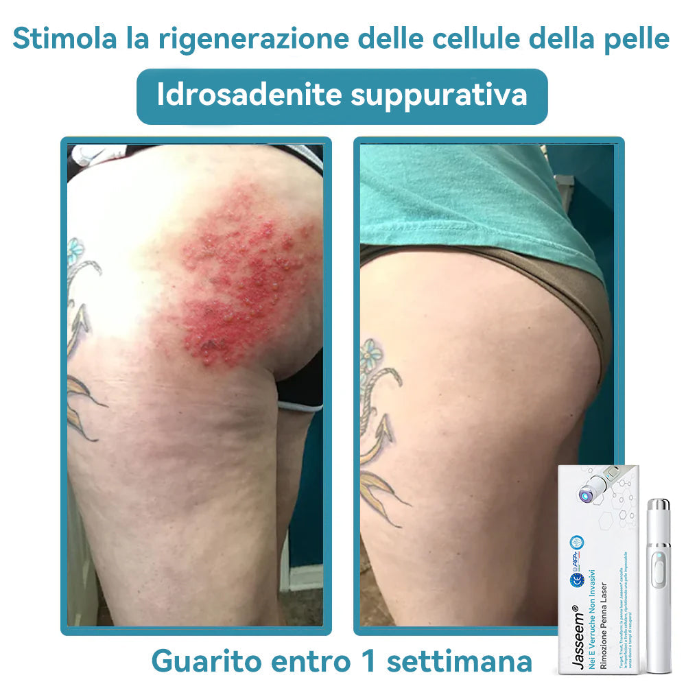 𝐉𝐚𝐬𝐬𝐞𝐞𝐦® Penna Laser Medica 🎉 (Tecnologia Laser al Carbonio – Efficace nel Rimuovere Nei, Verruche, Escrescenze Cutanee, Macchie di Pigmentazione e Altri Difetti della Pelle) 🔥