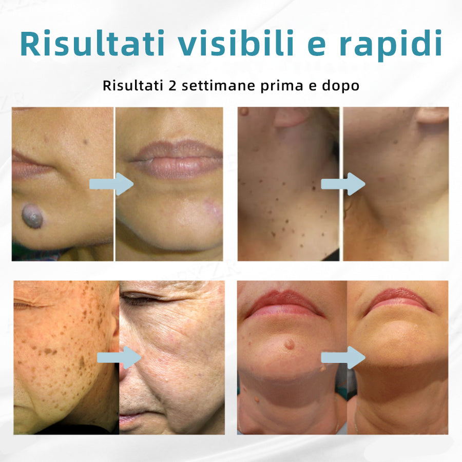𝐉𝐚𝐬𝐬𝐞𝐞𝐦® Penna Laser Medica 🎉 (Tecnologia Laser al Carbonio – Efficace nel Rimuovere Nei, Verruche, Escrescenze Cutanee, Macchie di Pigmentazione e Altri Difetti della Pelle) 🔥