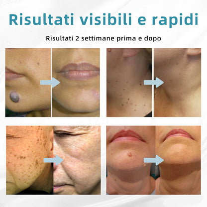 𝐉𝐚𝐬𝐬𝐞𝐞𝐦® Penna Laser Medica 🎉 (Tecnologia Laser al Carbonio – Efficace nel Rimuovere Nei, Verruche, Escrescenze Cutanee, Macchie di Pigmentazione e Altri Difetti della Pelle) 🔥