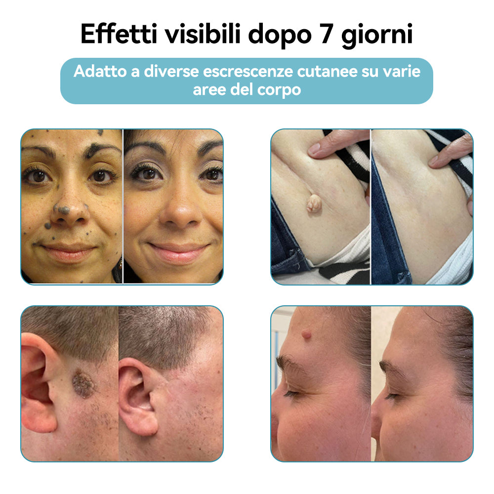𝐉𝐚𝐬𝐬𝐞𝐞𝐦® Penna Laser Medica 🎉 (Tecnologia Laser al Carbonio – Efficace nel Rimuovere Nei, Verruche, Escrescenze Cutanee, Macchie di Pigmentazione e Altri Difetti della Pelle) 🔥