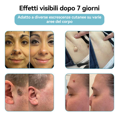 𝐉𝐚𝐬𝐬𝐞𝐞𝐦® Penna Laser Medica 🎉 (Tecnologia Laser al Carbonio – Efficace nel Rimuovere Nei, Verruche, Escrescenze Cutanee, Macchie di Pigmentazione e Altri Difetti della Pelle) 🔥