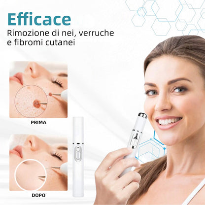 𝐉𝐚𝐬𝐬𝐞𝐞𝐦® Penna Laser Medica 🎉 (Tecnologia Laser al Carbonio – Efficace nel Rimuovere Nei, Verruche, Escrescenze Cutanee, Macchie di Pigmentazione e Altri Difetti della Pelle) 🔥