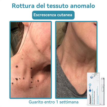 𝐉𝐚𝐬𝐬𝐞𝐞𝐦® Penna Laser Medica 🎉 (Tecnologia Laser al Carbonio – Efficace nel Rimuovere Nei, Verruche, Escrescenze Cutanee, Macchie di Pigmentazione e Altri Difetti della Pelle) 🔥