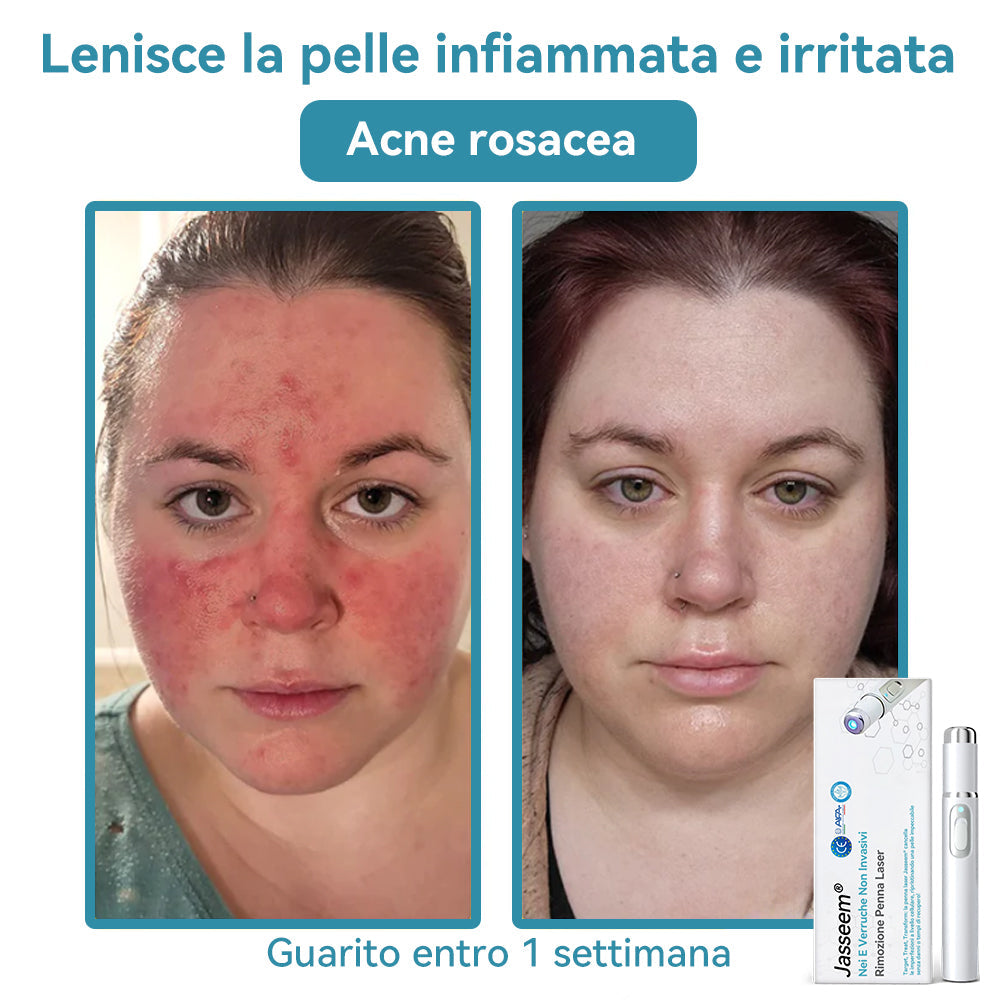𝐉𝐚𝐬𝐬𝐞𝐞𝐦® Penna Laser Medica 🎉 (Tecnologia Laser al Carbonio – Efficace nel Rimuovere Nei, Verruche, Escrescenze Cutanee, Macchie di Pigmentazione e Altri Difetti della Pelle) 🔥